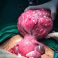 Uterine Fibroid Combo Pack Shrink Fibroid Naturally